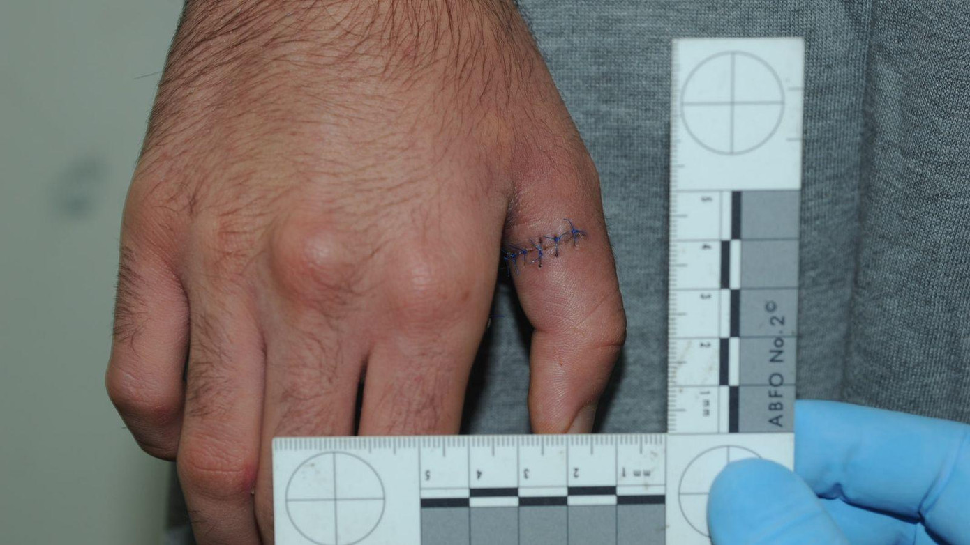 Vết thương trên tay Hussein. Ảnh: Sky News Vết thương trên tay Hussein. Ảnh: Sky News