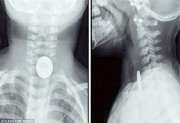 Bé 2 tuổi suýt tử vong vì nuốt phải cục pin phổ biến trong đồ chơi ảnh 2