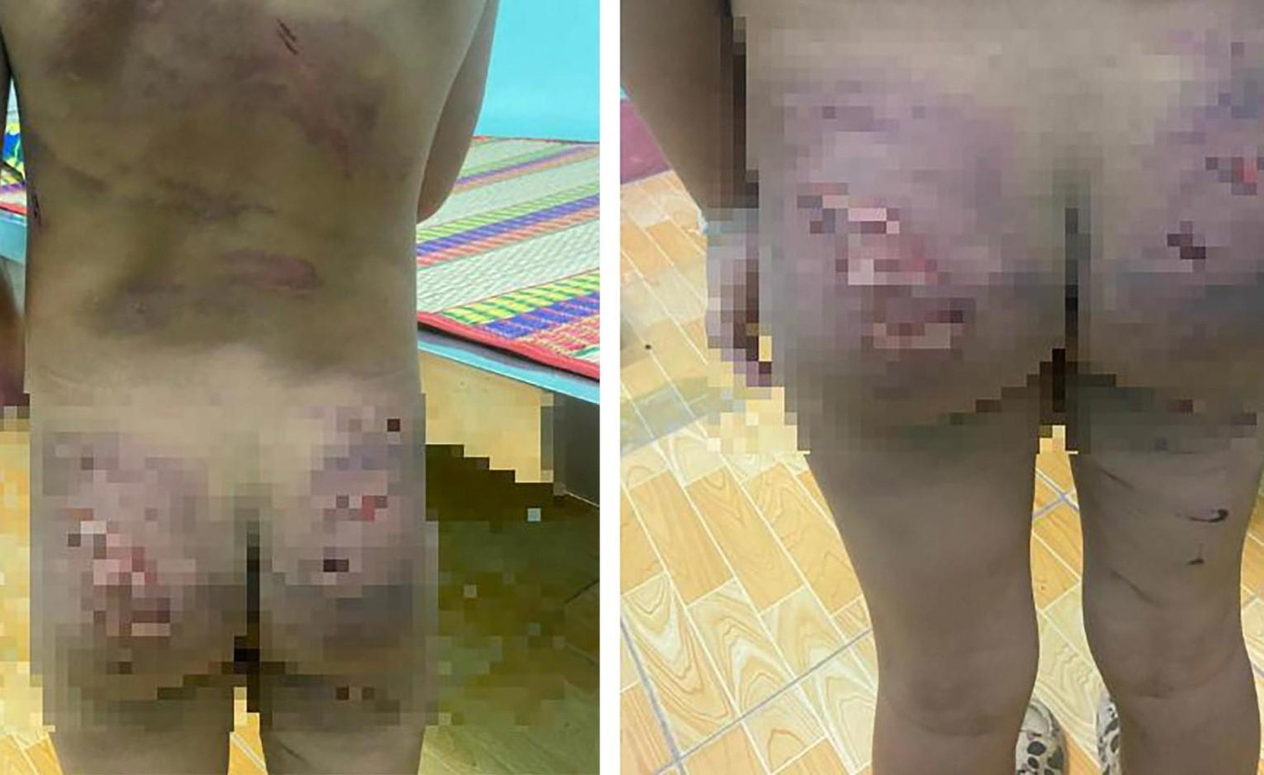 Bé gái 7 tuổi bị mẹ ruột và cha dượng đánh gây thương tích khắp cơ thể Bé gái 7 tuổi bị mẹ ruột và cha dượng đánh gây thương tích khắp cơ thể