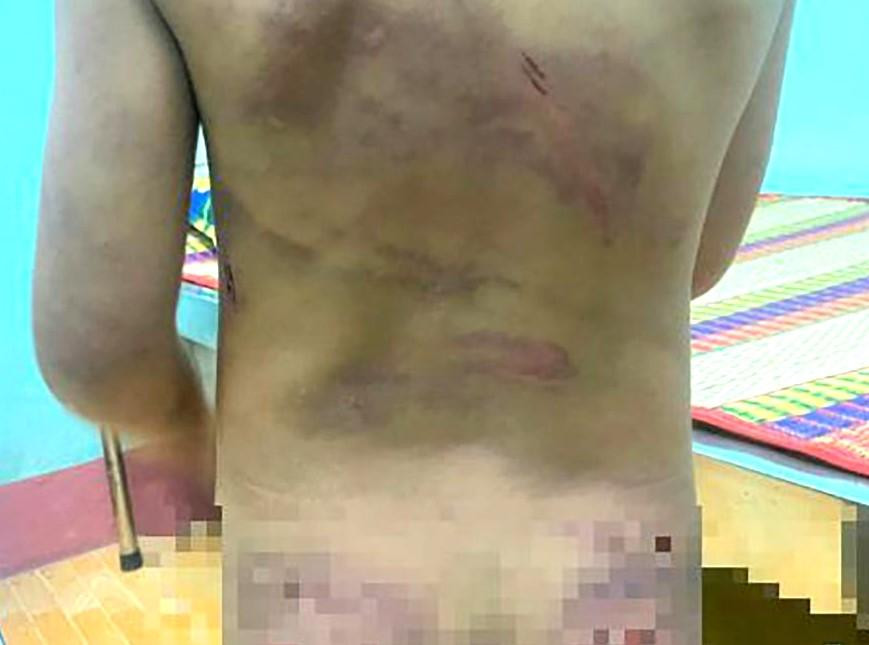 Bé gái bị cha dượng và mẹ ruột bạo hành