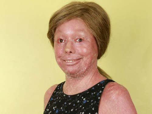 Căn bệnh hiếm gặp khiến làn da của Hunter bong tróc như vảy cá. Ảnh: Health.