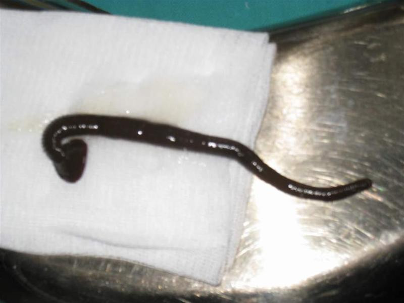 Con đỉa vừa được gắp ra khỏi khí quản bệnh nhân. Ảnh: Hoàng Lam Con đỉa vừa được gắp ra khỏi khí quản bệnh nhân. Ảnh: Hoàng Lam