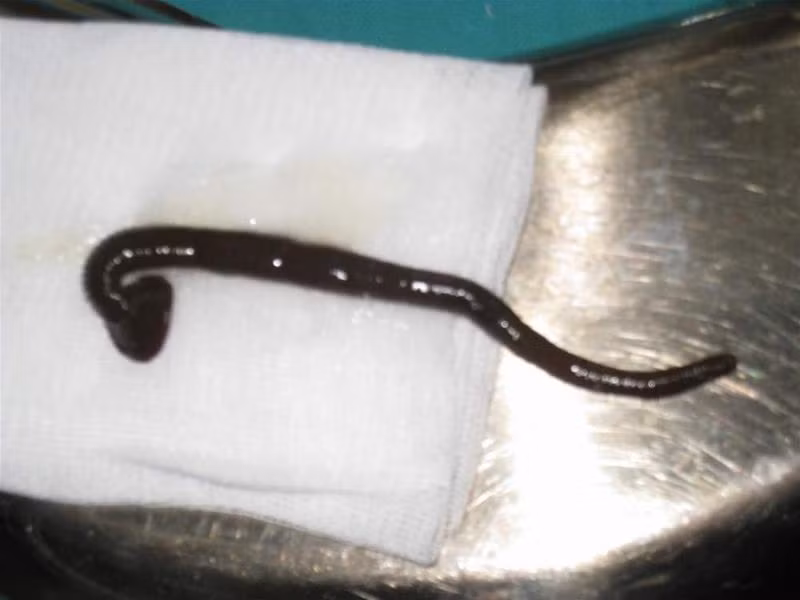 Con đỉa vừa được gắp ra khỏi khí quản bệnh nhân. Ảnh: Hoàng Lam