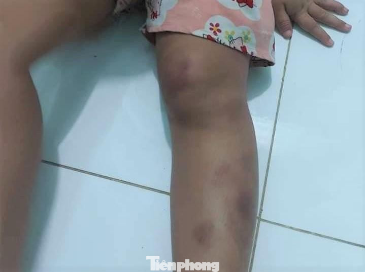 Cháu bé bị đánh thương tích đầy mình