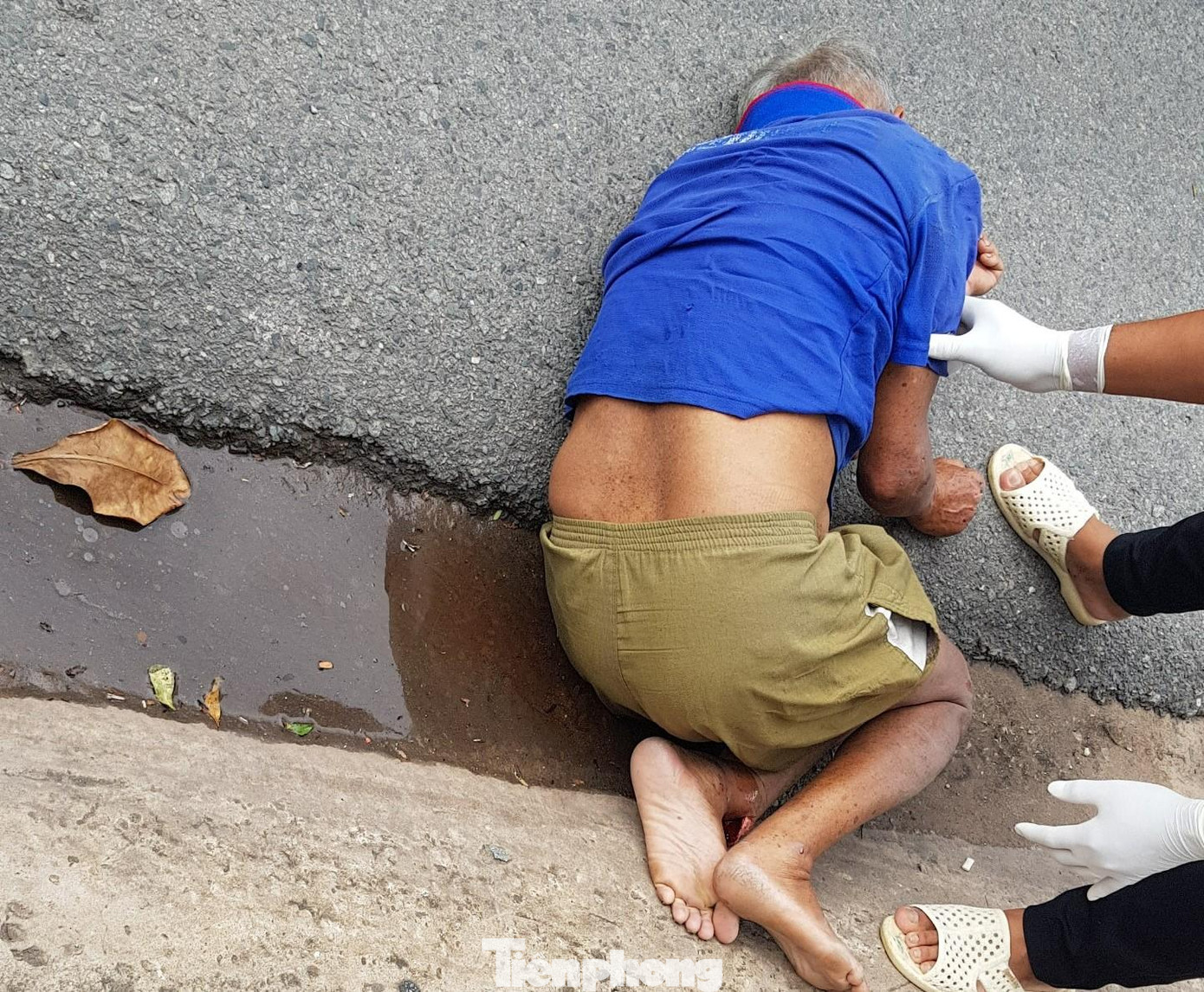 Cụ ông bị gãy chân, chấn thương sọ não