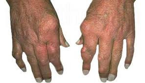 Bàn tay bị biến dạng do viêm khớp dạng thấp
