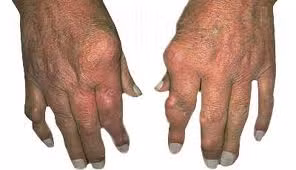 Bàn tay bị biến dạng do viêm khớp dạng thấp