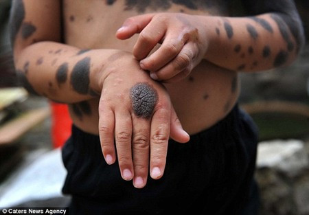 Tay, chân và mặt của Liu Jiangli nhiều vết lốm đốm 