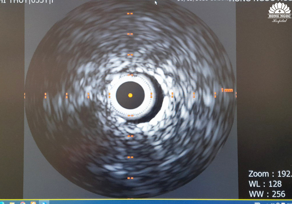 Hình ảnh siêu âm trong lòng mạch IVUS sau can thiệp