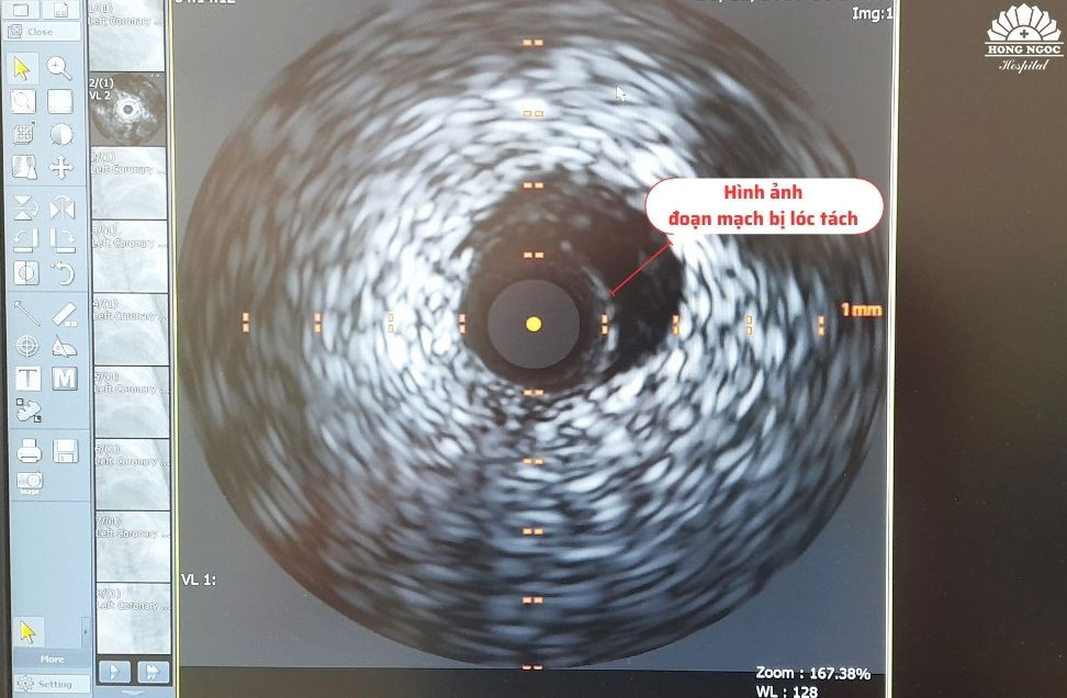 Hình ảnh siêu âm trong lòng mạch IVUS trước can thiệp của bệnh nhân