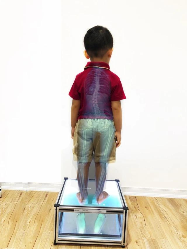 Bàn chân bẹt và cong vẹo cột sống có liên quan mật thiết đến nhau