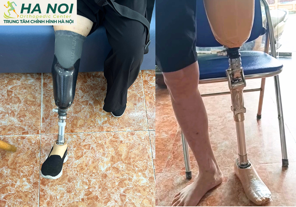 Hình ảnh bệnh nhân tại Trung tâm chỉnh hình Hà Nội Hình ảnh bệnh nhân tại Trung tâm chỉnh hình Hà Nội