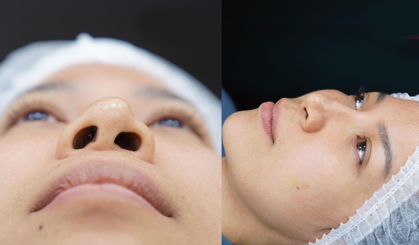 Biến chứng mũi lệch vẹo sau khi nâng ở spa thẩm mỹ Biến chứng mũi lệch vẹo sau khi nâng ở spa thẩm mỹ