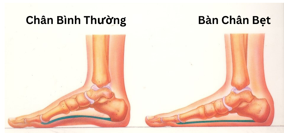 Bàn chân bẹt là tình trạng không hình thành hõm bàn chân
