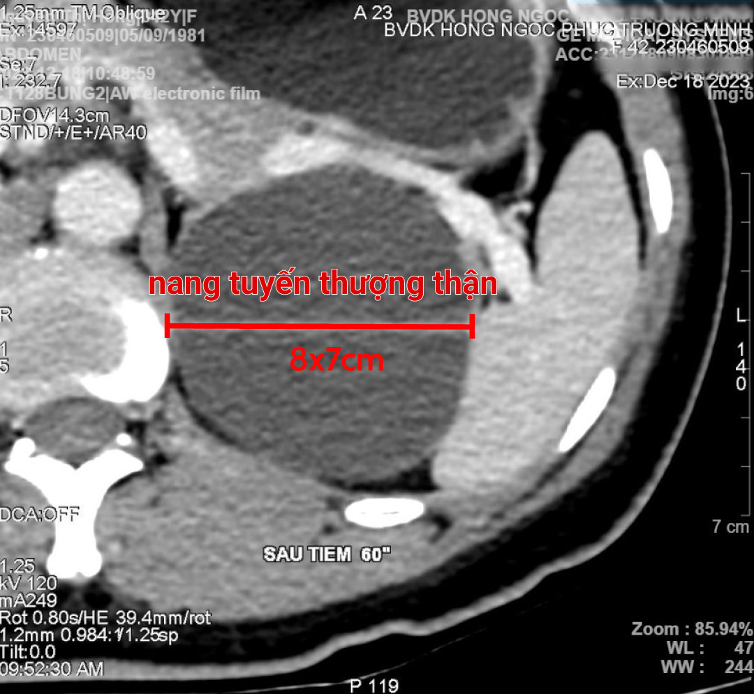 Kết quả chụp CT cho thấy chị H. có một cấu trúc nang có kích thước lớn 8x7 cm Kết quả chụp CT cho thấy chị H. có một cấu trúc nang có kích thước lớn 8x7 cm