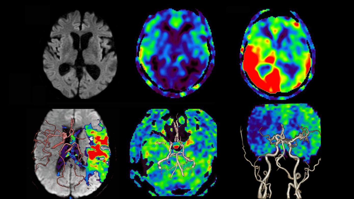 Hình ảnh chụp cộng hưởng từ tưới máu não không sử dụng thuốc tương phản (MRI não)