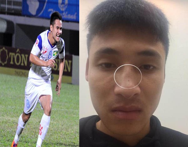 Tiền đạo SLNA bị tố đấm gãy sống mũi cầu thủ Đắk Lắk ảnh 1