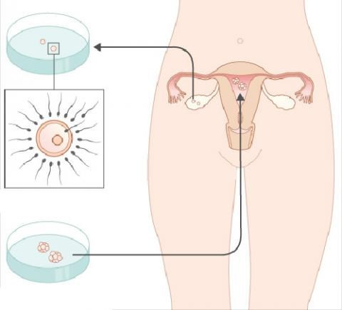 Thụ tinh trong ống nghiệm (IVF). Đây là phương pháp điều trị hiếm muộn cho những cặp vợ chồng thực sự không thể thụ thai một cách tự nhiên. Bác sĩ sẽ lấy trứng của người phụ nữ ra và cho kết hợp với tinh trùng trong phòng thí nghiệm (trong ống nghiệm). Sau khi sự thụ tinh xảy ra, phôi được chuyển vào tử cung của người phụ nữ để mang thai 9 tháng 10 ngày. Phương pháp này có xác suất thành công từ 28-75%