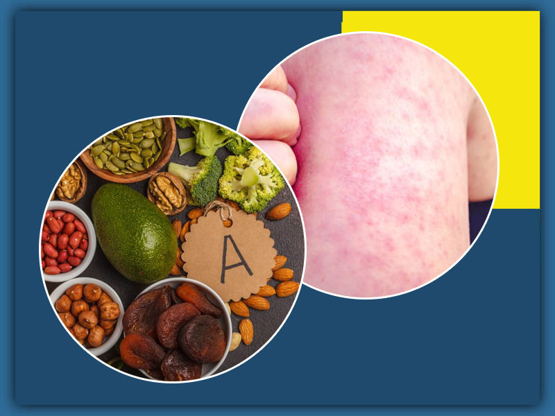 Dinh dưỡng đúng cách giúp trẻ bị bệnh sởi nhanh hồi phục hơn. Dinh dưỡng đúng cách giúp trẻ bị bệnh sởi nhanh hồi phục hơn.