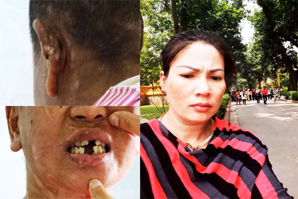 Không phải bà Hà bẻ răng, cắt tai Y Nhiêu thì ai đã làm việc này ?.