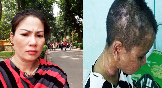 Bà Nguyễn Thị Hà tra tấn người giúp việc Y Nhiêu đến 