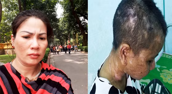 Bà Nguyễn Thị Hà tra tấn người giúp việc Y Nhiêu đến 