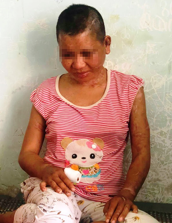 Trên người Y Nhiêu dày đặc các vết thương khác nhau do bà Hà gây ra