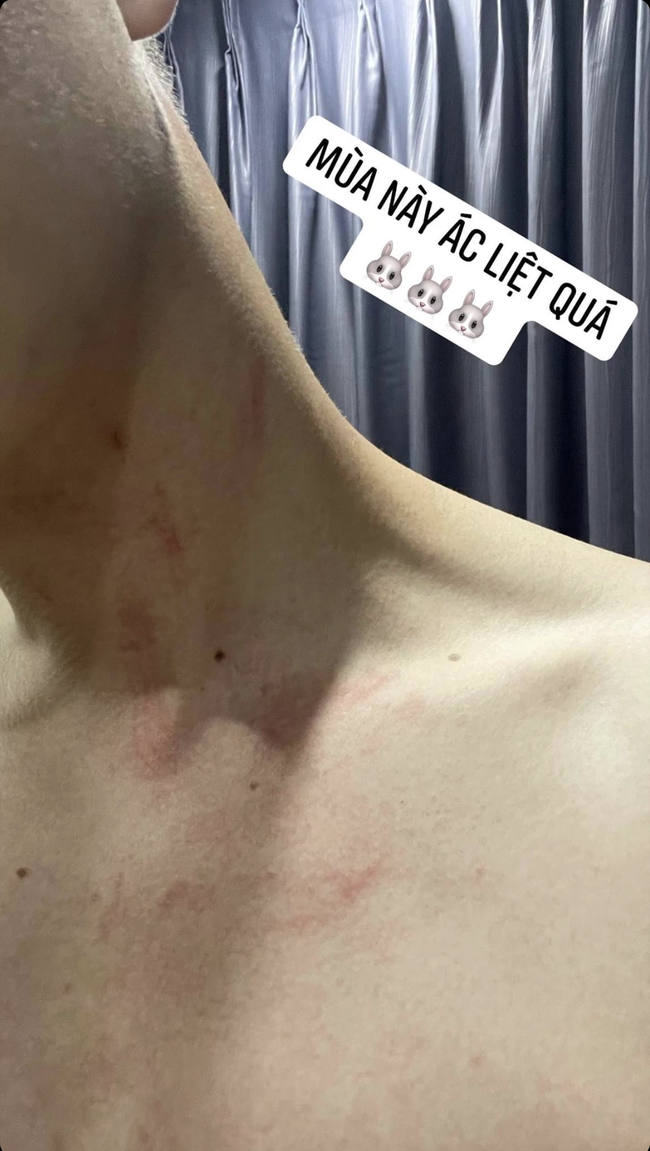 Ngô Kiến Huy đăng tải hình ảnh với nhiều vết trầy xước trên cổ và vai, anh chàng bày tỏ: "Mùa này ác liệt quá!".