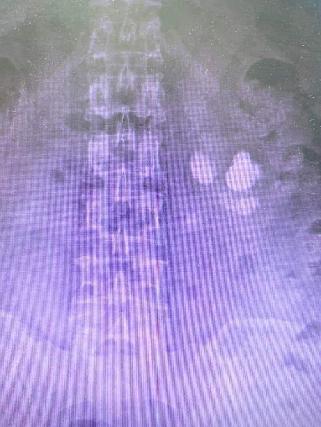 Những viên sỏi thận có kích thước lớn (các khối màu trắng bên phải) ở thận trái của bệnh nhân được phát hiện trên kết quả kiểm tra hình ảnh Những viên sỏi thận có kích thước lớn (các khối màu trắng bên phải) ở thận trái của bệnh nhân được phát hiện trên kết quả kiểm tra hình ảnh