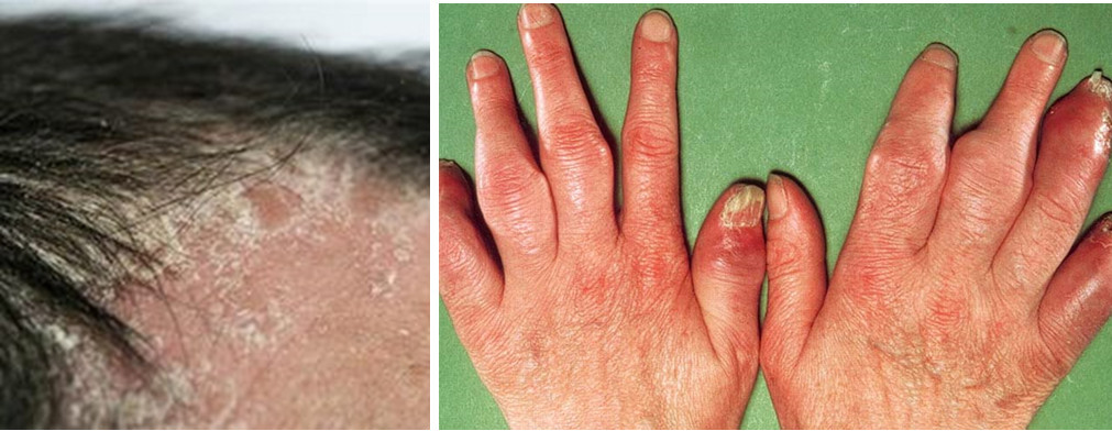 Các biến chứng của bệnh vảy nến luôn là nỗi ám ảnh của người mắc bệnh vảy nến Các biến chứng của bệnh vảy nến luôn là nỗi ám ảnh của người mắc bệnh vảy nến