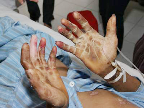 Bệnh nhân điều trị viêm cầu lợn