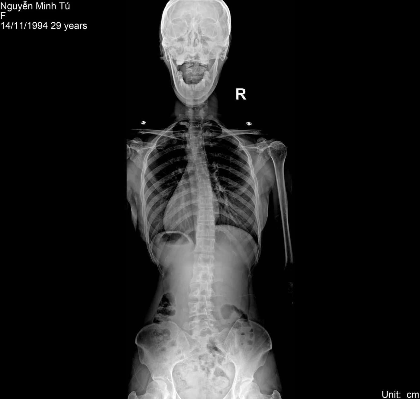 Minh Tú mắc nhiều bệnh liên quan đến xương khớp như mất đường cong sinh lý cổ, thoái hóa đốt sống cổ, cong vẹo cột sống, thoát vị đĩa đệm... Minh Tú mắc nhiều bệnh liên quan đến xương khớp như mất đường cong sinh lý cổ, thoái hóa đốt sống cổ, cong vẹo cột sống, thoát vị đĩa đệm...