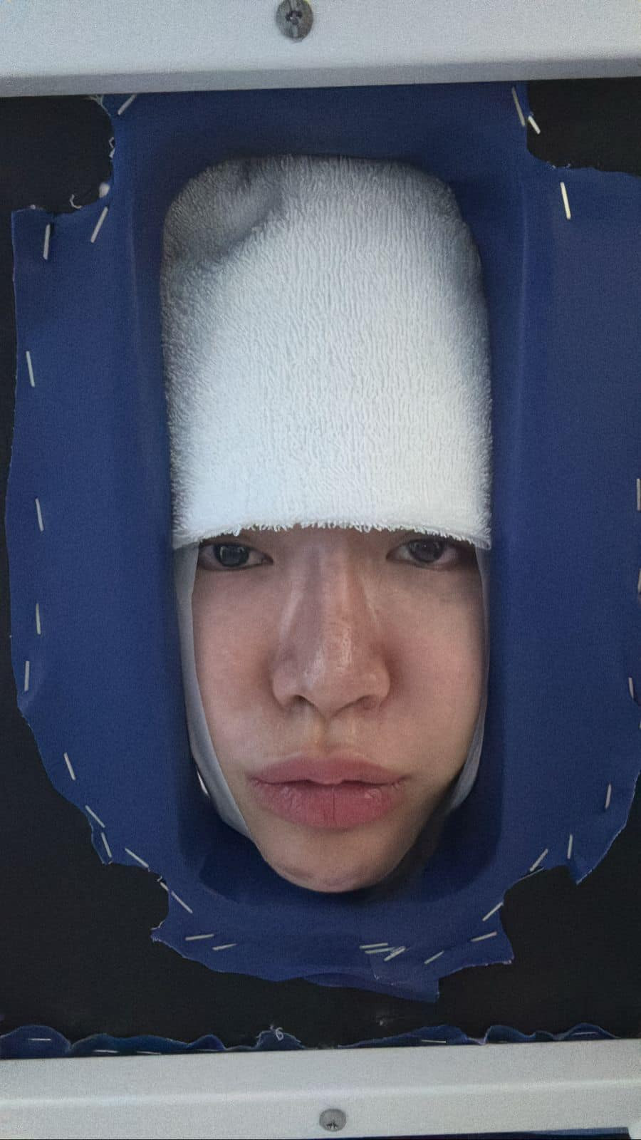 Minh Tú mắc nhiều bệnh liên quan đến xương khớp như mất đường cong sinh lý cổ, thoái hóa đốt sống cổ, cong vẹo cột sống, thoát vị đĩa đệm... Minh Tú mắc nhiều bệnh liên quan đến xương khớp như mất đường cong sinh lý cổ, thoái hóa đốt sống cổ, cong vẹo cột sống, thoát vị đĩa đệm...