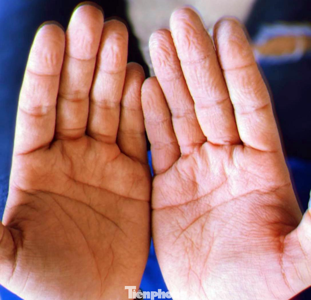 Bàn tay của Bảo Ngân sau thời gian dài đeo găng tay, sử dụng dung dịch sát khuẩn. Ảnh: NVCC