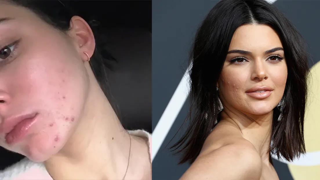 Trong lần hiếm hoi chụp mặt mộc, "chân dài triệu đô" Kendall Jenner phát tín hiệu "ét ô ét" với làn da chi chít mụn.
