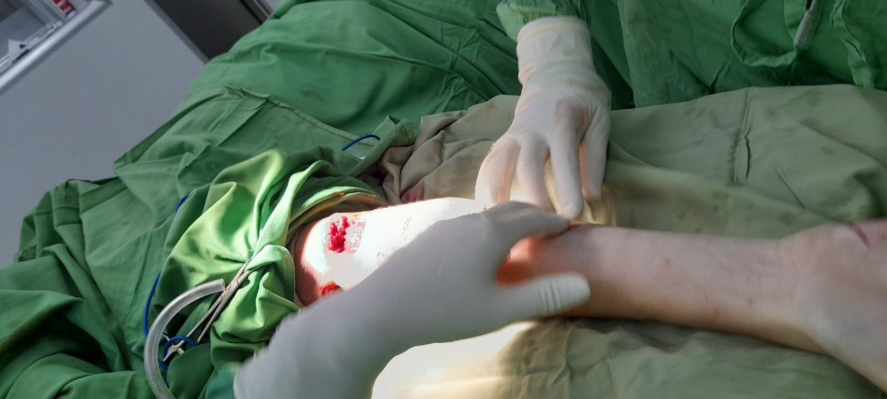 Các bác sĩ phẫu thuật vết thương bị chó cắn cho anh Paul. Các bác sĩ phẫu thuật vết thương bị chó cắn cho anh Paul.