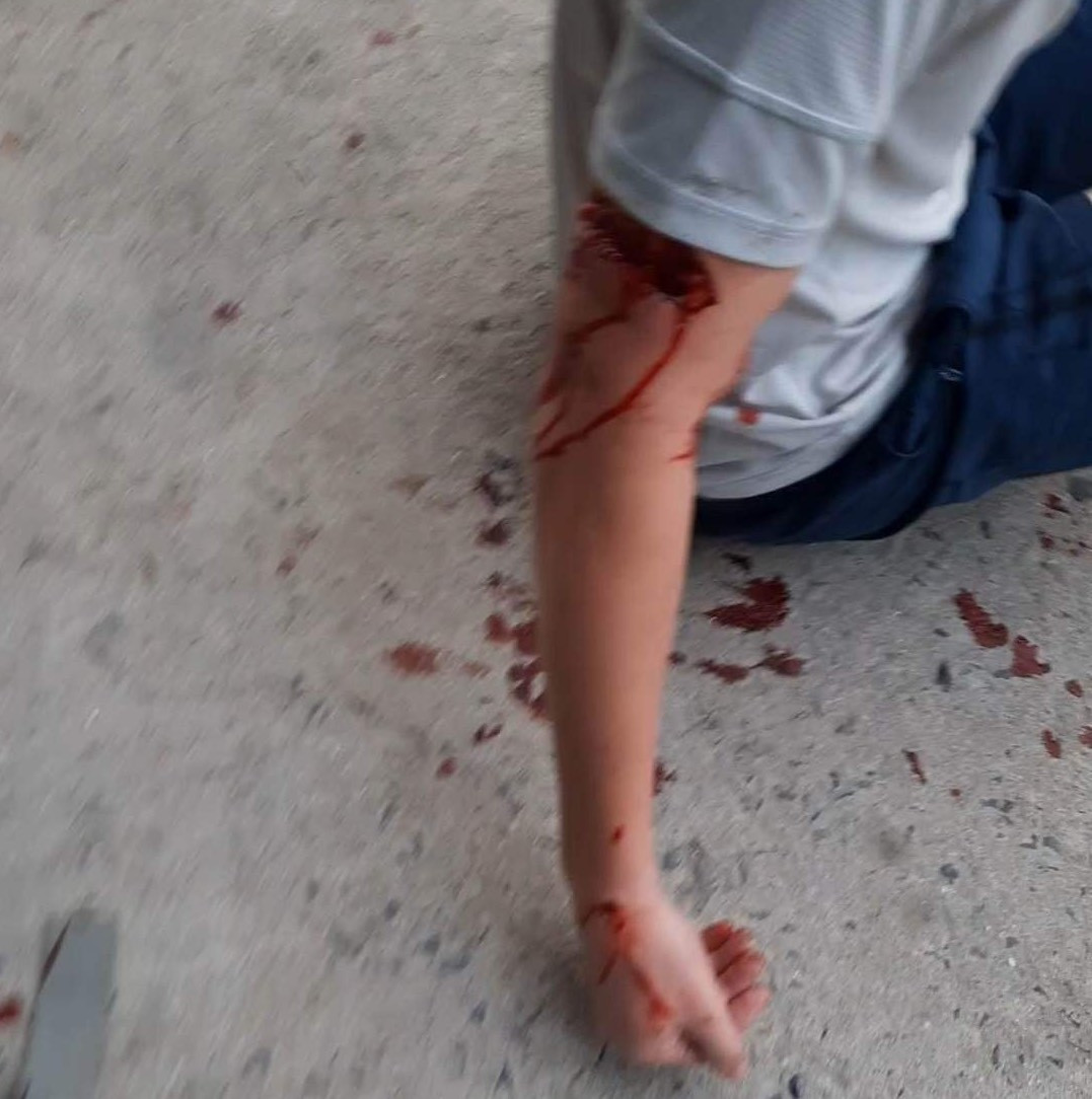 Du khách nước ngoài bị chó của người dân cắn rách tay ở TP. Nha Trang. Du khách nước ngoài bị chó của người dân cắn rách tay ở TP. Nha Trang.