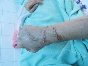 Cánh tay của chị Thúy đã hồng hào và phục hồi tốt 