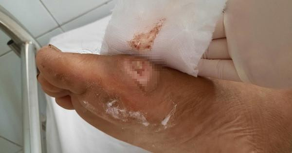 Tổn thương do khuẩn gây bệnh Whitmore gây ra.