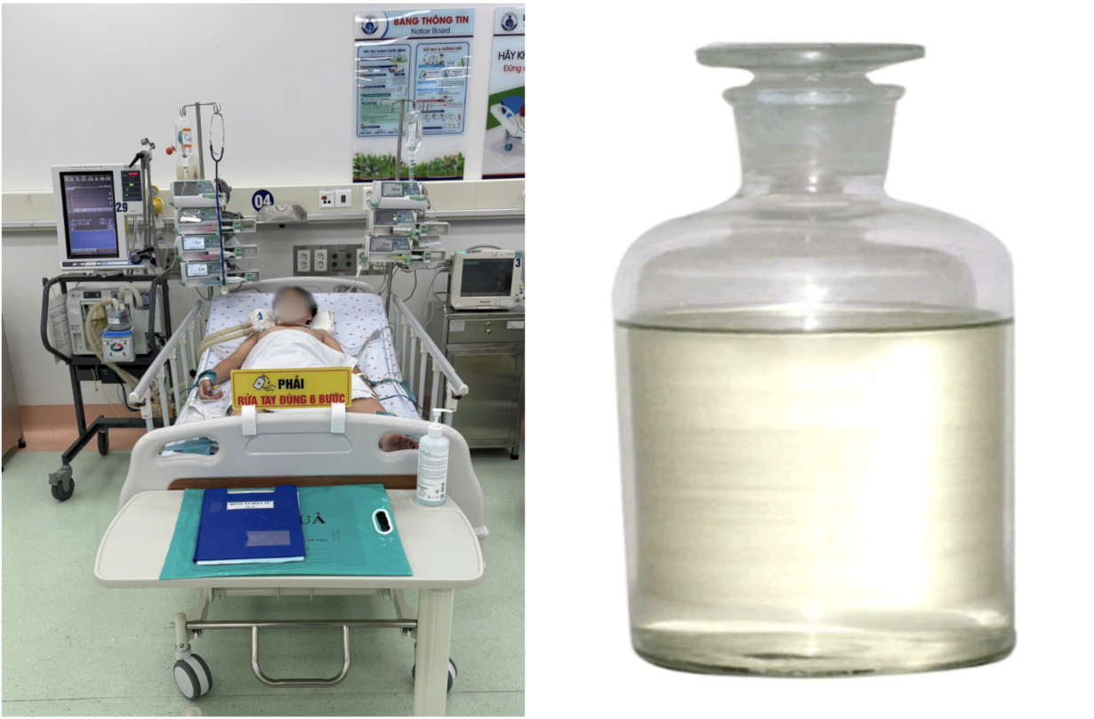 Một bé trai 13 tuổi khoẻ mạnh đột ngột hôn mê, suy hô hấp nặng do hít phải khí độc hại styrene dùng để hàn nhựa (hoá chất được gia đình mua về để hàn nhựa, chai hoá chất còn để trong cốp xe hơi, chưa kịp lấy ra).