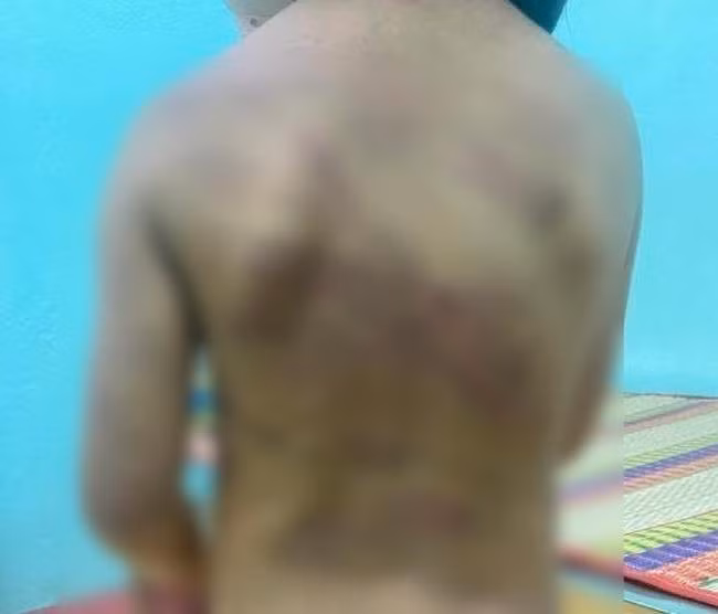 Bé gái nghi bị bạo hành với nhiều vết thương trên người. (Ảnh: TTXVN)