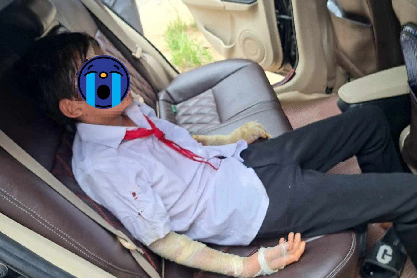 Học sinh bị thương sau sự cố nổ bóng bay. (Ảnh: Nguyễn Giang) Học sinh bị thương sau sự cố nổ bóng bay. (Ảnh: Nguyễn Giang)