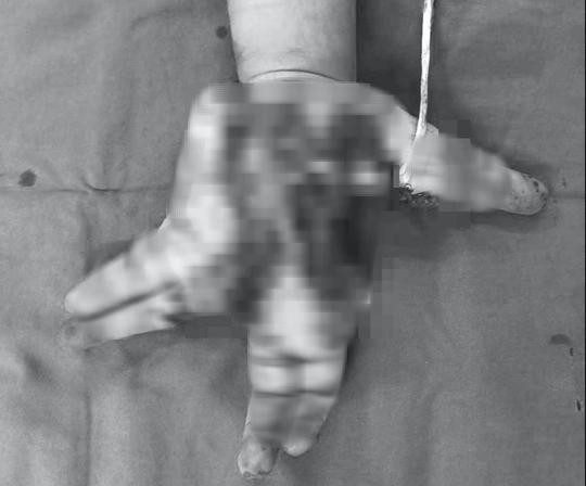 Thiếu niên nát bàn tay trái do nổ điện thoại. (Ảnh do bệnh viện cung cấp cho báo chí)