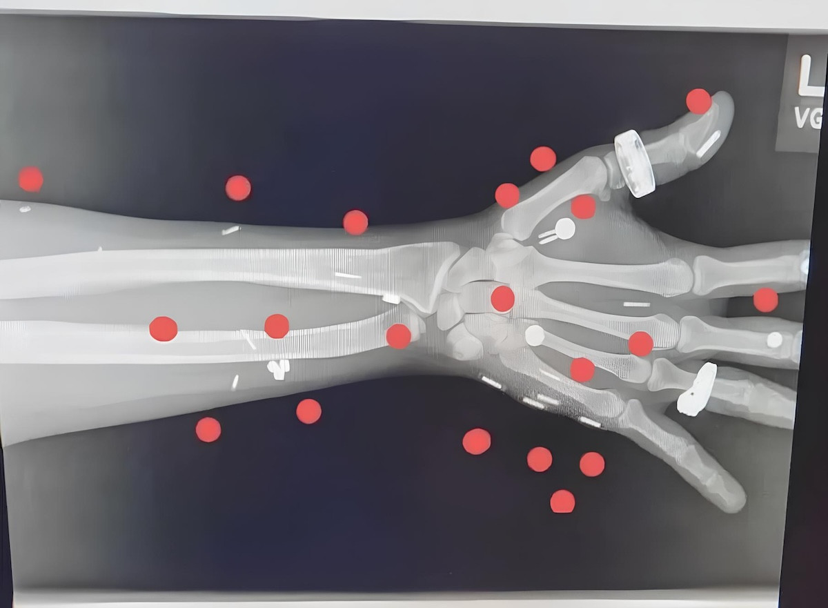 Mặc dù đã đạt được thành công với 52 bộ phận cấy ghép, Synn vẫn chưa dừng lại. Mặc dù đã đạt được thành công với 52 bộ phận cấy ghép, Synn vẫn chưa dừng lại.