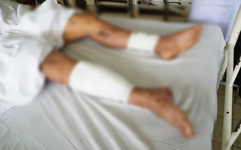 Tổn thương ở chân của bệnh nhân do pháo nổ.