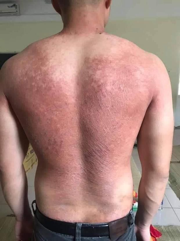 Những nhân viên y tế cháy da cháy thịt khi phơi mình giữa cái nắng đầu Hè.