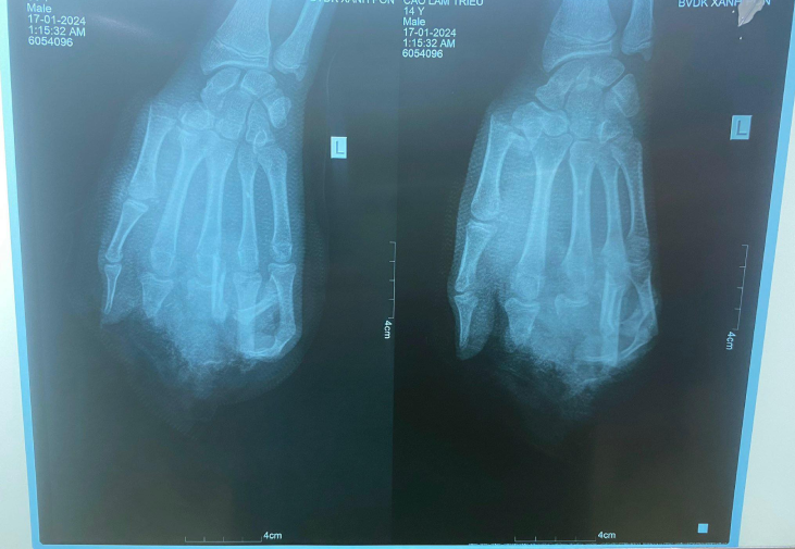 Hình ảnh phim chụp X-quang của bệnh nhân. (Ảnh: BVCC) Hình ảnh phim chụp X-quang của bệnh nhân. (Ảnh: BVCC)