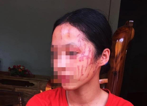 Hình ảnh nữ sinh lớp 8 bị cào xước hết mặt. Hình ảnh nữ sinh lớp 8 bị cào xước hết mặt.