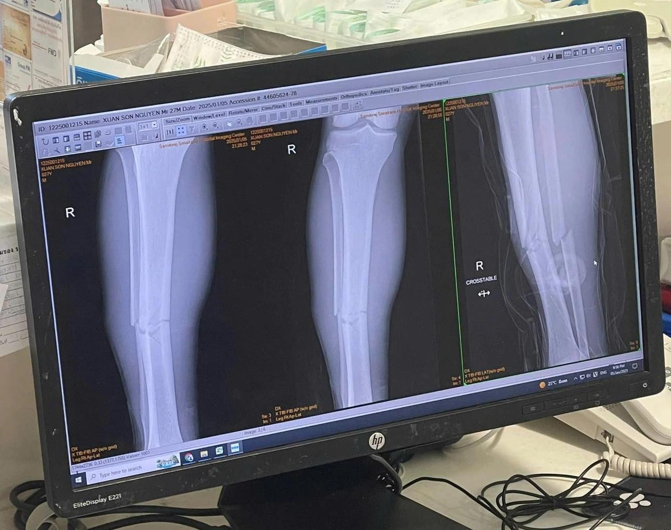 Hình ảnh chụp phim xương ống đồng bị gãy của Xuân Son. Hình ảnh chụp phim xương ống đồng bị gãy của Xuân Son.