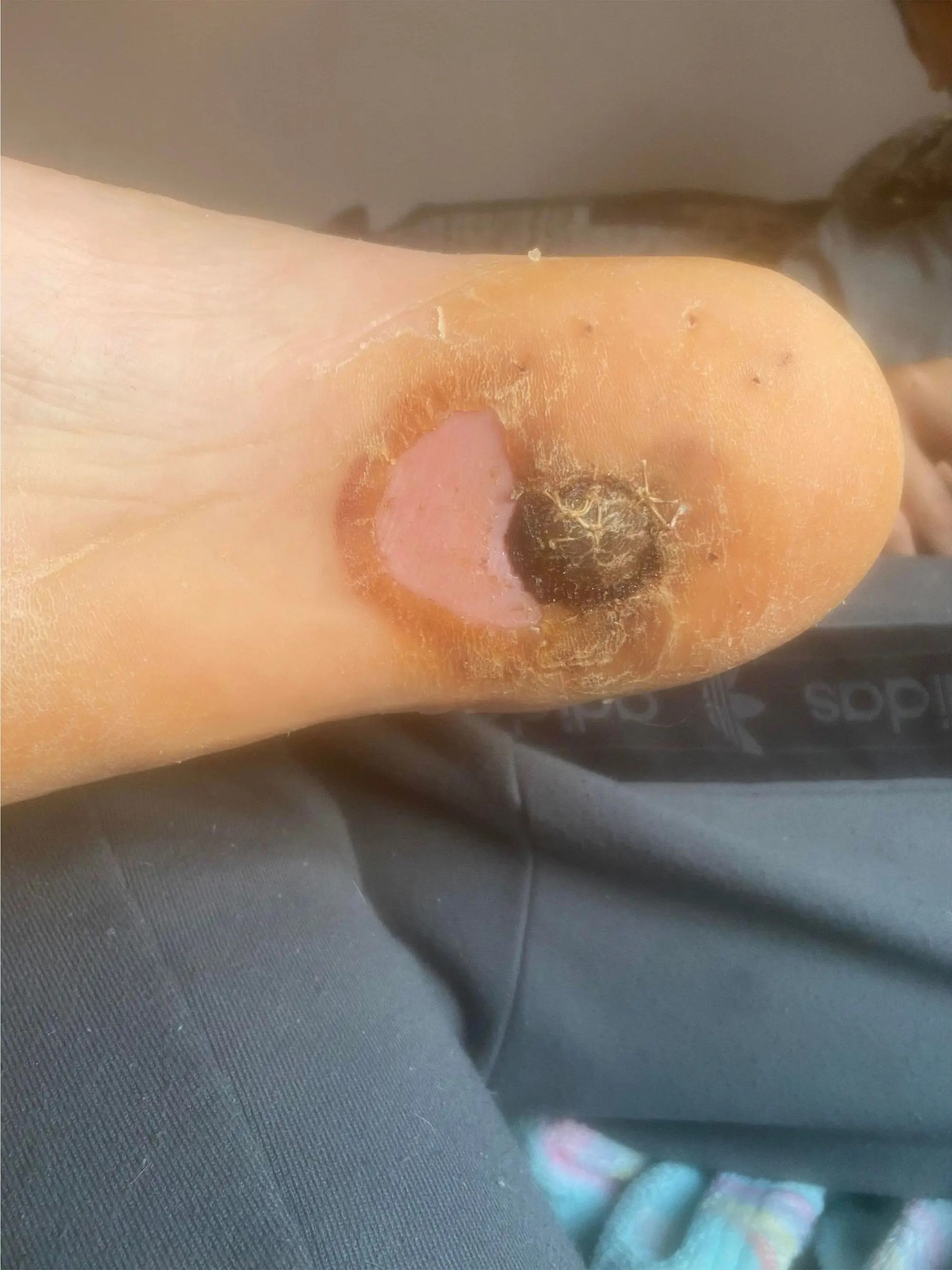 Điếu thuốc lá điện tử xuyên vào chân cậu bé